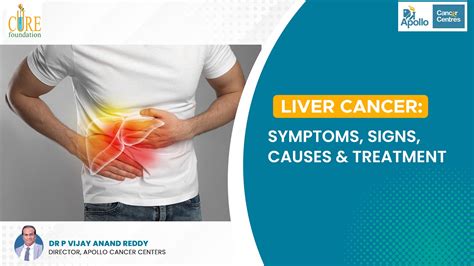 Liver Cancer: Symptoms, Signs, Causes & Treatment .